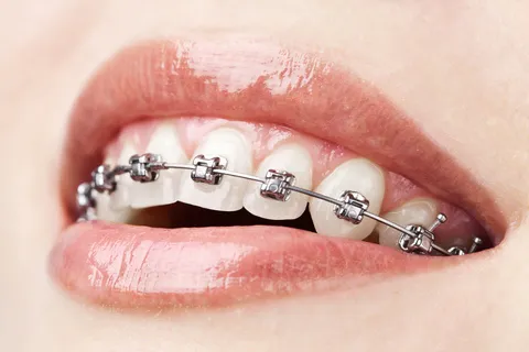 A HELPFUL SITE ON ORTHODONTICS