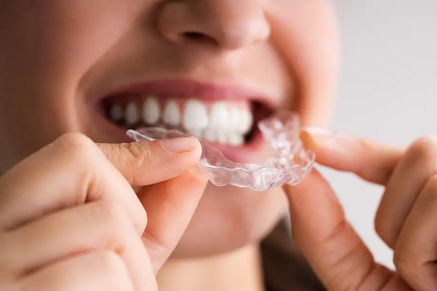 How Long Do You Really Need to Wear Your Retainer?