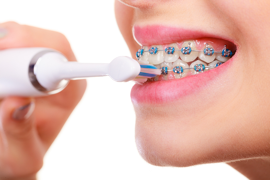 Why an Electric Toothbrush is a Game-Changer for Braces Wearers