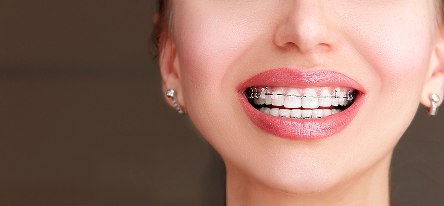 A Comprehensive Guide to Self-Ligating Braces in Decatur, GA: Advantages and Treatment Options