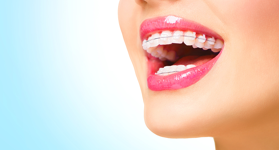 Self-Ligating Braces In Decatur, GA: A Modern Solution for a Straighter Smile